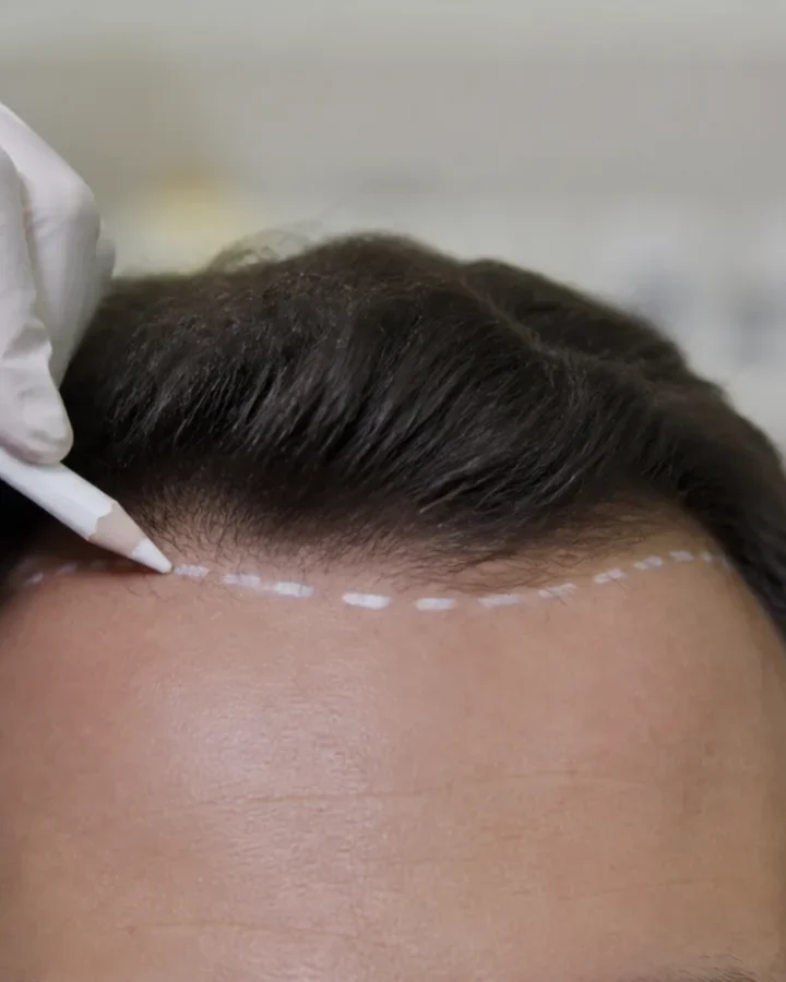 Tıraşsız Saç Ekimi uygulaması — Estetik Hair Antalya